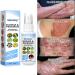 Meellop Herbal Psoriasis, Eczema, Vitiligo Relief Spray - Skin Repair, Stop Burning & Itching (5Pcs) - Buy Online on GoSupps.com