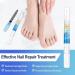 XIFEPFR Toenail Repair Pen - Nail Fingernail Repair Pen for Thick  Broken  Discolored Nails - Restores Healthy Strong Nails - 4PCS - Buy Online on GoSupps.com