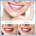 Buy Cosmetic Veneers for Upper & Lower Teeth | Temporary Tooth Solutions & Braces Covers - Buy Online on GoSupps.com