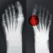 Hallufix Bunion Protector and Correction Splint | for Men and Women | Hallux Valgus Bunion Corrector | Helps straighten The Big Toe and Provide Bunion Relief of Pain | Premium Device Made in Germany UK: 2 -3 - EU: 34-36 - Buy Online on GoSupps.com