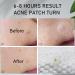 Zunci Pimple Patches (120 Patches) - Hydrocolloid Anti-Acne Spot Treatment with Salicylic Acid - Buy Online on GoSupps.com