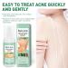 Back Acne Treatment Spray With Herbal Formula 2% Salicylic Acid & Tea Tree Oil - Body Acne Solution 120ml 1PCS - Buy Online on GoSupps.com