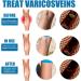 Varicose Veins Cream - Spider Veins Repair & Treatment for Legs | Relief Ointment - Buy Online on GoSupps.com