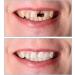 Buy Mxrfactory Instant Veers Pebble Gel Provisional Dentures - Quick Upper & Lower Jaw Teeth Repair for a Confident Smile - 5 Pairs - Buy Online on GoSupps.com