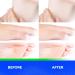 ACCBTECH Liquid Wart Remover - Fast-Acting Advanced Treatment for Common and Genital Warts (10ml) - Buy Online on GoSupps.com