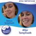 Temporary Tooth Replacement Kit - DIY Filling for Missing Tooth x2 - Buy Online on GoSupps.com