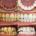 Tooth whitening essence tooth restoration and spot removal liquid professional tooth whitening liquid coffee tea stains and cola to clean yellow teeth (1 piece *10 cotton swabs) - Buy Online on GoSupps.com