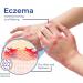 Eczema Therapy Spray Natural Eczema Relief Spray Eczema Treatment Fast Acting Itch Relief (3Pcs) - Buy Online on GoSupps.com