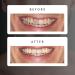Affordable Teeth Whitening Kit | Professional-Grade LED Light & Gel for Easy At-Home Use - Buy Online on GoSupps.com