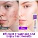Azelaic Acid 12% Facial Serum Skin Hyaluronic Acid and Niacinamide Serum Redness Relief Fade - Buy Online on GoSupps.com