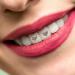 Shop Tooth Gem Jewelry - Fashionable Rhinestone Tooth Ornaments | International Shipping - Buy Online on GoSupps.com