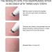 Bite Treatment Sting Suction For Hiking Backpacking And Camping Anti itchy Pen Stop Itch Bite Relief Anti itching Pen Entire Family Bug Bee Bite Sting Kit - Buy Online on GoSupps.com