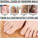 Ingrown Toenail Treatment Oil - Cuticle Care for Ingrown Toenails, Nail Fungal Treatment - 10ml - Buy Online on GoSupps.com