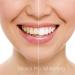 10% Carbamide Peroxide Teeth Whitening Gel - 10 pc Tooth Bleaching Dispensers - Buy Online on GoSupps.com