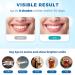 SINORIKO Teeth Whitening Kit - 6X LED Light, Fast 10 Min Results, 3 Whitening Gels, Remineralizing Gel, Home Teeth Whitener - Buy Online on GoSupps.com