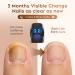 Effective Nail Fungus Cleaning Light Device | FSA & HSA Eligible | Easy Home Treatment for Thick Discolored Toenails - Buy Online on GoSupps.com
