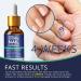 Nail Fungus Treatment - Extra Strength Solution for Toenail & Fingernail Restoration - Buy Online on GoSupps.com