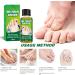 ERFD Toenail fungus care Fungal Nail Cure for Toenails Extra Strong 30ml Anti Fungal Toe Nails Treatment - Buy Online on GoSupps.com