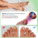 Ikeen Nail Fungus Treatment Device - Effective Onychomycosis Solution with Red & Blue Light Therapy | Painless & Fast Nail Health Improvement - Buy Online on GoSupps.com