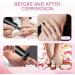 Ranrose Multifunction Electric Callus Remover - 2 in 1 Rechargeable Foot File with Nail Drill Bit & 6 Speeds | Professional Pedicure Tool for Smooth Feet - Black - Buy Online on GoSupps.com