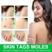 Skin Tag & Wart Remover Cream - Advanced Treatment Formula, Natural Ingredients - 20g - Buy Online on GoSupps.com