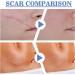 CenryUSA Clear Scars Tape - Silicone Scar Tape for C-Section Surgery - Buy Online on GoSupps.com
