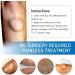 Lipoma Removal Cream Cr me d' limination de lipomes Cellulite Removal Exfoliating Cream Get Rid of Your Fatty Lipoma Lumps (2pcs) - Buy Online on GoSupps.com