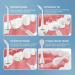Mornwell Water Flosser Replacement Nozzles - Compatible with D50 D52 F32 F29 - International Shipping Available - Buy Online on GoSupps.com