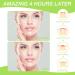 120 Pack Mandabloom Acne Pimple Patches with Tea Tree Oil & Salicylic Acid - Hydrocolloid Acne Dots for Face Zits & Breakouts - Buy Online on GoSupps.com