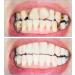 4 Couples Cosmetic Veneers - Temporary Prostheses for Immediate Comfort | Upper & Lower Snap-On Teeth Solutions - Buy Online on GoSupps.com