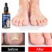 Ingrown Toenail Treatment Oil for Thick, Damaged Nails - Toenailplus Anti Paronychia Relief - Buy Online on GoSupps.com