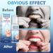 Melanther Retainer Cleaner & Toothbrush - Braces/Aligner Whitening Foam for ClearCorrect, Essix, Vivera & Hawley Trays - Denture Cleaner (120ml) - 2 Pack - Buy Online on GoSupps.com