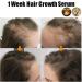 Ginger Huile de croissance des cheveux Ginger anti-chute 7 jours repousse 7 jours huile germ e au gingembre pour nourrir les racines des cheveux r pare les cheveux ab m s nourrit les racines des - Buy Online on GoSupps.com