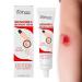 Bedsore Wound Care Cream 20g Fast Healing For Wound Healing Soress Relief Healing Cream Relief Chafed Skin Hard To Heal Skin Soress Soothing Relief Of Bed Soress Pressure Soress Relief Cream