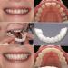 Giural Veneer Snaps Teeth - 2 Pairs of Instant False Teeth for Men & Women | Immediate Prostheses for a Perfect Smile - Buy Online on GoSupps.com