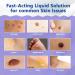 Maximum Strength Wart Remover Liquid with Salicylic Acid - Fast-Acting Wart Treatment for Common Plantar & Genital Warts - 0.68 floz/20ml - Buy Online on GoSupps.com