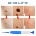 Skin Tag Remover Kit - Easy Application Device for Small to Medium Skin Tags (2mm-5mm) - Blue Kit - Buy Online on GoSupps.com