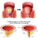 FEETT Heca Herbal Hemorrhoid Capsules - Natural Relief Suppository - Buy Online on GoSupps.com