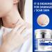 Advanced Scar Removal Cream - Effective Treatment for Surgical Acne C-Section Burns & Stretch Marks - Old & New Scars - Buy Online on GoSupps.com