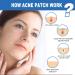 Buy Facial Acne Patches - Hydrocolloid Treatment with Tea Tree Oil & Salicylic Acid | 216 Tablets for Pimples & Blemishes - Buy Online on GoSupps.com