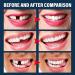 70PCS Temporary Tooth Repair Kit | False Tooth Replacement & Crowns | Front Teeth Repair | Denture & Oral Care - Buy Online on GoSupps.com