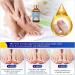 Ingrown Toenail Treatment 30ml Ingrowing Toenail Treatment Toenail Anti Paronychia Relief Oil Correction Ingrown Toenail Softening Drops for Damaged Discolored Thick Nail - Buy Online on GoSupps.com