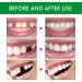 Temporary Tooth Repair Set | DIY Instant Veneers & Provisional Dentures | Best Dental Repair Kit for International Shipping - Buy Online on GoSupps.com