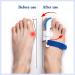 Bunion Valgus Corrector for Men and Women - Adjustable Protective Cover for Big Toe Joint - Hallux Valgus Relief - Buy Online on GoSupps.com
