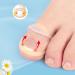 10 Pcs Toe Nail Corrector Ring Stretch Resistant Silicone Brace for Ingrown Toenails Transparent Reusable Design - Buy Online on GoSupps.com