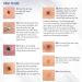 Mole Removal & Skin Tag Repair Gel Set - Remove Effectively at Home - Buy Online on GoSupps.com