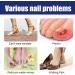 Ingrown Toenail Treatment - 30ML Ingrown Toenail Correction Drops - Nail Helper Ingrowth Toenail Treatment Oil - Trimming Toenail Softening Drops - Nail Fungal Treatment - Buy Online on GoSupps.com