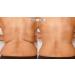 Skinnies Instant Lifts - 5 Pair Back Lifts - PATENTED MADE USA FLATTENS BACK FAT INSTANTLY Clear Adhesive Strips Instantly Smooth Back Fat. Go Backless!