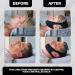 Adjustable Anti-Snoring Chin Strap for CPAP Users - Comfortable, Breathable, and Effective Snoring Solution for Men and Women - Buy Online on GoSupps.com