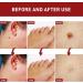 Aibyks 2 Skin Tag Corrector | Natural Mole Remover Cream Natural Skin Tag Removal Mole Corrector for Face Wart and Body Wart - Buy Online on GoSupps.com